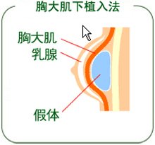 揭秘：明星美胸究竟怎么来的